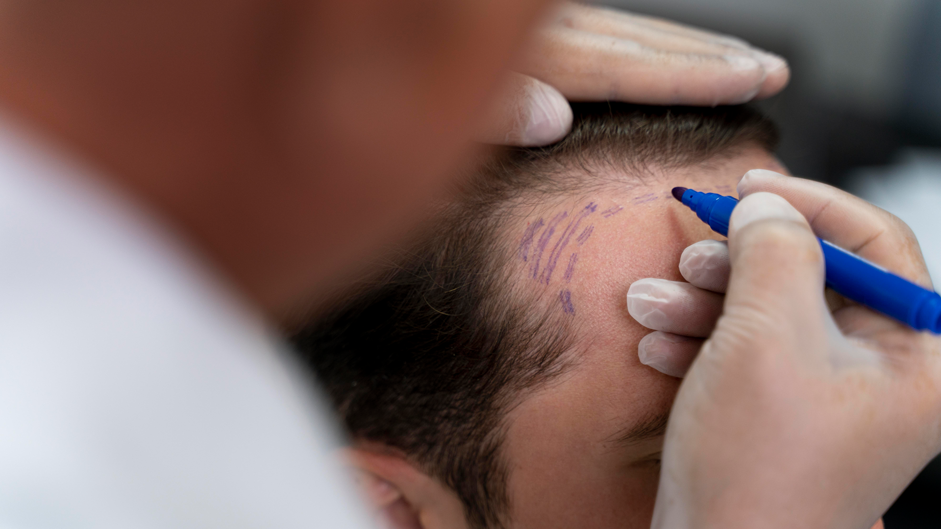 Hair Transplant-1