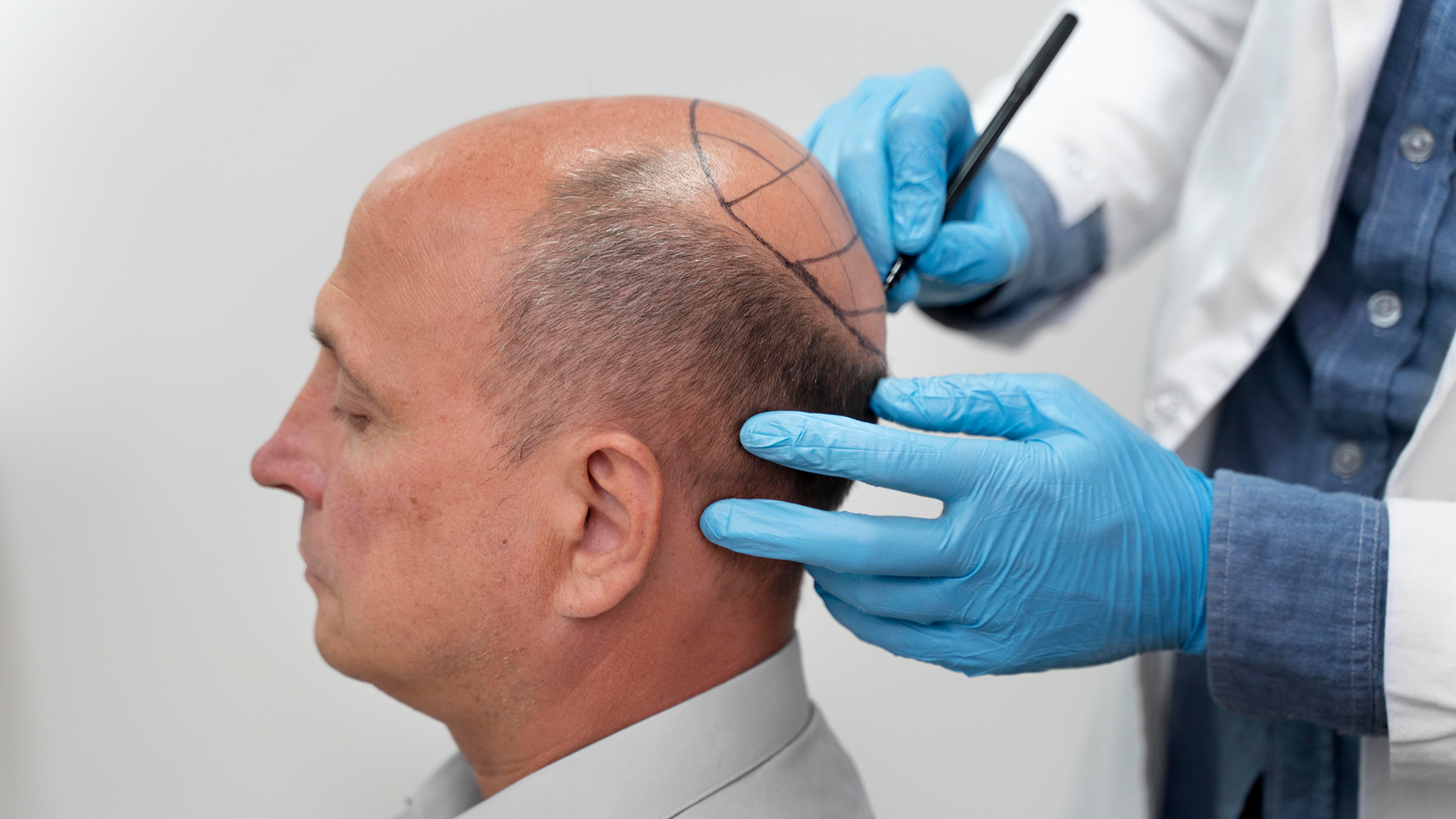Hair Transplant-2
