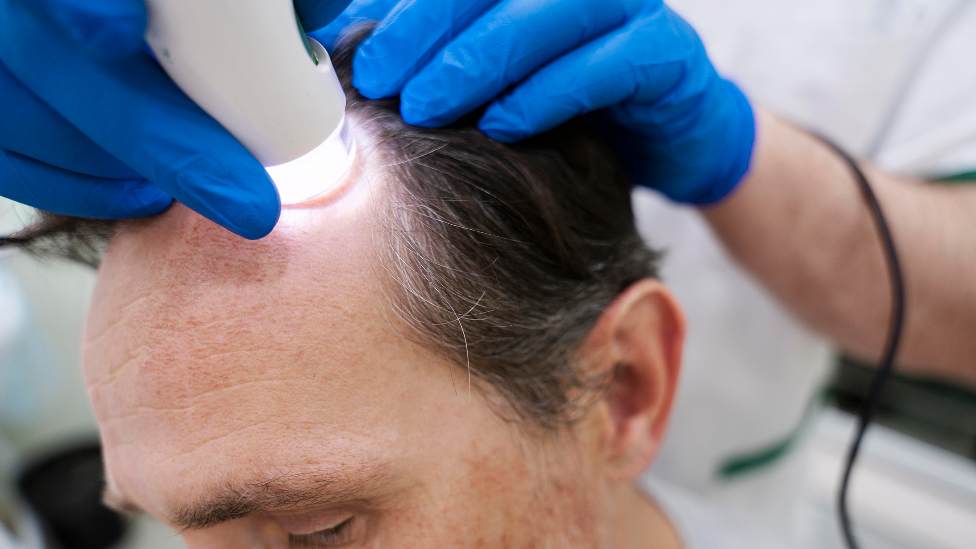 Hair Transplant-3