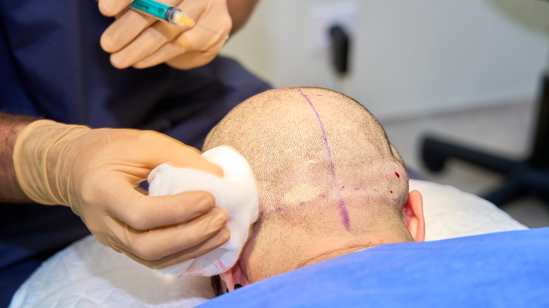 Hair Transplant-4