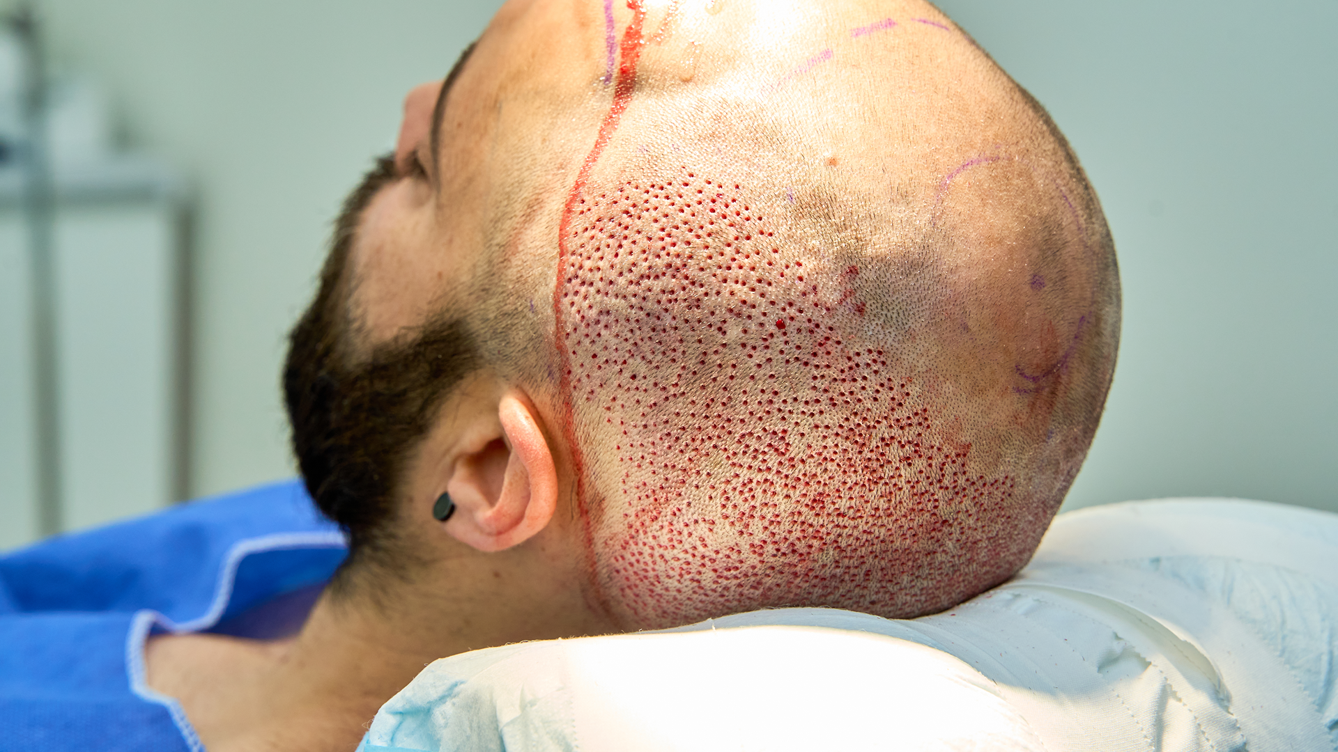 Hair Transplant-7