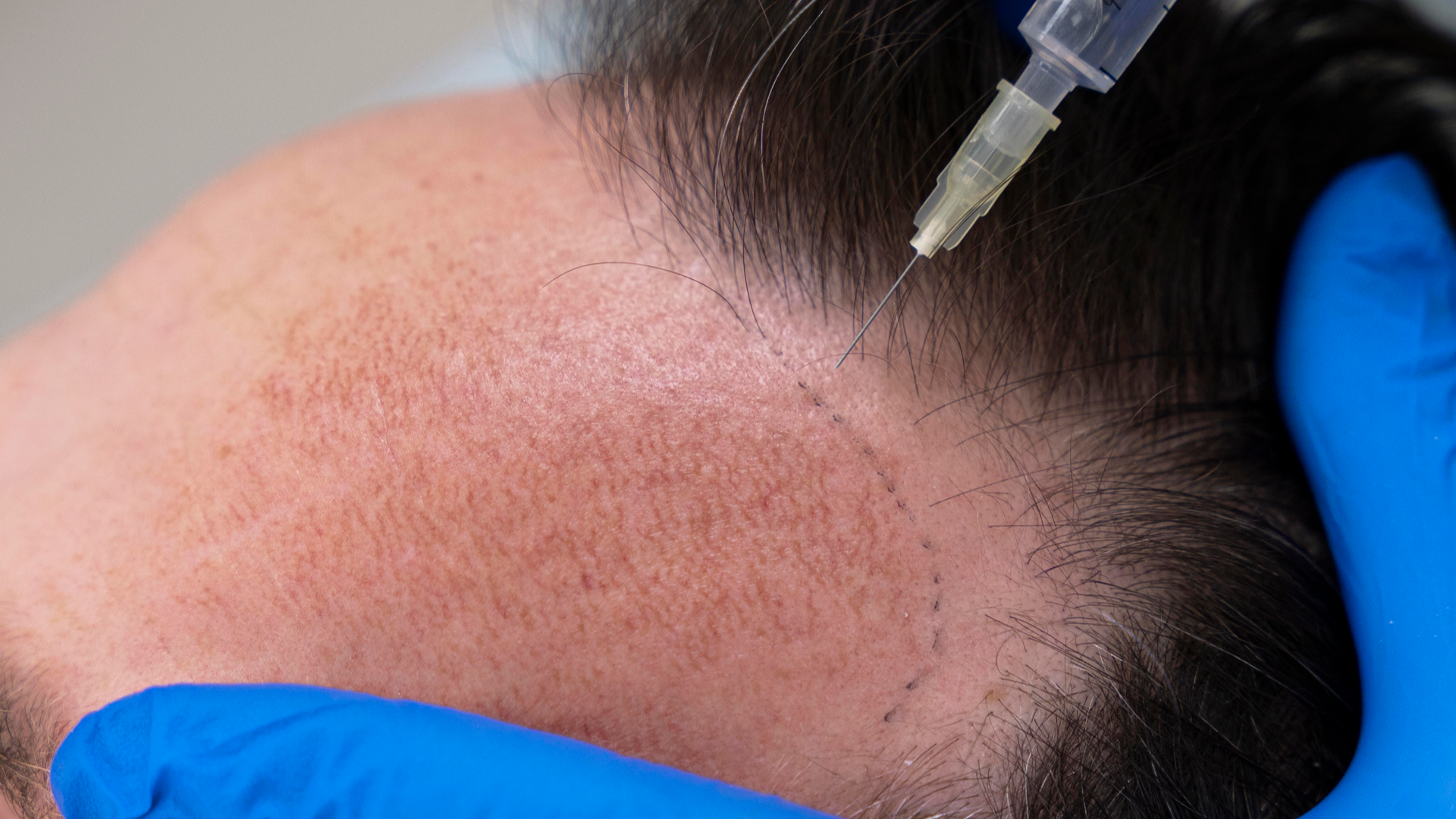 Hair Transplant-8